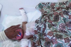 Memilukan, Bayi 10 bulan di Inhil alami luka bakar 60 persen