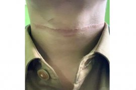 Tersabet benang layangan, warga Muara Teweh luka di leher