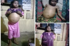 Donita Marbun penderita tumor asal Tapteng butuh uluran tangan