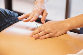 Akupuntur bisa membantu menangani keluhan migrain