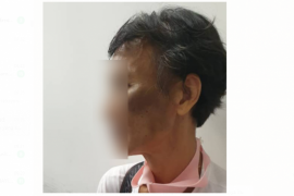 Sadis, TKI disiksa majikan di Malaysia hingga wajah lebam