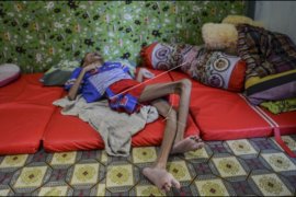 Penderita gizi buruk