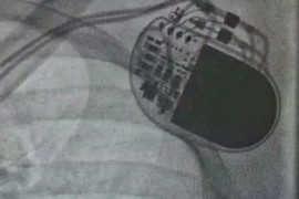 Ahli: Alat pacu jantung mampu  bertahan 15 tahun di dalam tubuh manusia