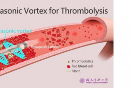 NTHU researchers develop ultrasonic vortex thrombolytic device