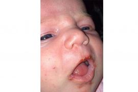 KPA Maluku: Bayi juga bisa terinfeksi herpes simpleks, begini penjelasannya