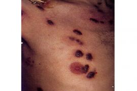 KPA Maluku: penderita Aids di Maluku pada 2020 didominasi pengangguran, begini penjelasannya