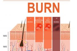 Mendinginkan luka bakar gunakan air mengalir bisa cegah luka memburuk