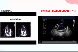 Hal ini yang dirasakan orang dengan gagal jantung