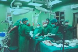 Kembar siam berhasil dipisahkan