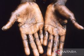 WHO catat 3.200 lebih kasus cacar monyet dan satu kematian secara global