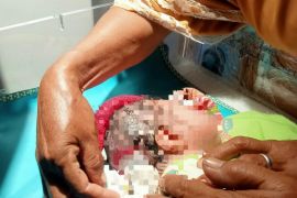 Seorang bayi di Lombok Tengah lahir dengan kondisi kepala bolong