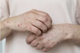 Dinkes: Kota Bogor tidak dalam status KLB Campak