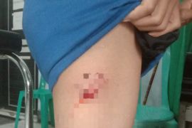 Tiga anak di Dompu digigit anjing rabies dari di bokong sampai wajah