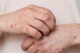 34 orang dirawat akibat terkena campak dan rubela di Papua Tengah