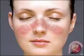 Gejala yang patut dicurigai sebagai penyakit lupus