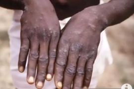 Mpox: Jakarta continues close contact tracing to fight transmission