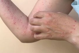 Mpox cases detected in five provinces: Health Ministry