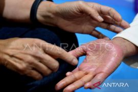 Artikel: Mengenal psoriasis dan menangani dampak psikologis