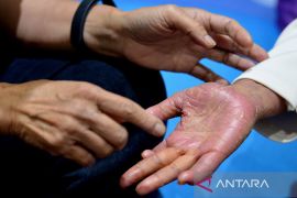 Kerentanan terhadap stres tingkatkan risiko psoriasis pada pria