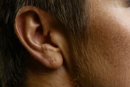 Waspada pertumbuhan rambut tak biasa tanda kondisi kulit langka