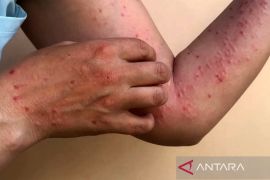 Satu santri di Meranti diduga terinfeksi cacar monyet meninggal dunia