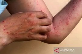 Dokter: Jagung parut dapat tingkatkan risiko iritasi pada luka cacar