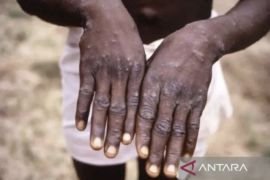 Cacar Air cuma sekali seumur hidup? Ini fakta di balik infeksi Varicella-zoster