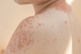 Anak cacar air tetap perlu mandi agar kulit bersih dan nyaman