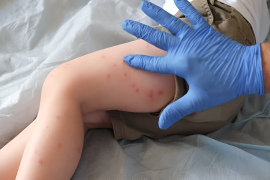 Dinkes Kota Tangsel catat penyakit campak capai 538 kasus