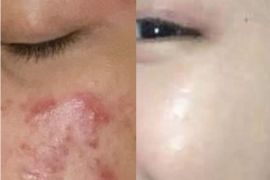 Kiat mengatasi jerawat dengan pemilihan produk dan perawatan yang tepat