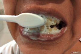 Tanda gusi mengalami peradangan yang sering dianggap remeh dan diwaspadai