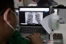 Dokter: Batuk lama hingga berat badan turun bisa jadi gejala awal TBC