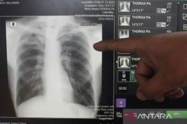 Dinkes Bandarlampung gunakan X-ray untuk deteksi pasien TBC