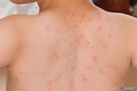 WHO: Kematian campak turun 88 persen sejak 2000 tapi kasus meningkat