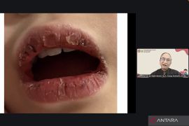 Waspadai gejala kawasaki pada anak yang sering salah diagnosis