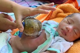 Bayi dengan kelainan usus keluar dari perut di Pandeglang butuh bantuan donatur