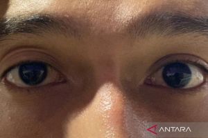 Mengenal Ptosis, kondisi mata telihat "ngantuk" menurut medis&nbsp;