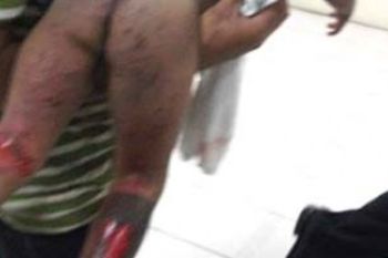 Sorang Bocah Karimun Luka Bakar Akibat ledakan Tabung Gas Karbit