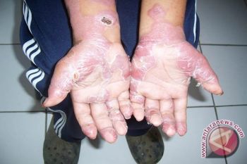 Jepang dan Belanda obati kusta di Madura