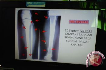 Sejumlah paku masih tertanam di kaki Supiyati
