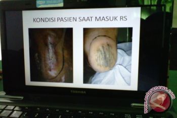 Belasan paku kembali dikeluarkan dari kaki Supiyati