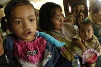 Masyarakat diajak ikuti operasi bibir sumbing gratis