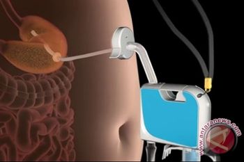  AspireAssist, pompa perut anti-gemuk