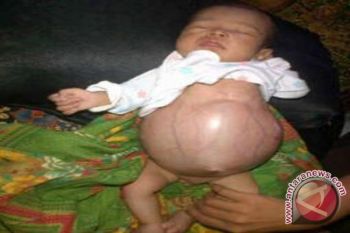 Bayi Perut Sebesar Bola Kaki Perlu Bantuan Donatur