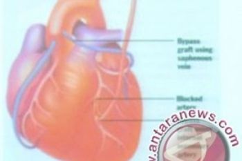 Kelainan Irama Jantung Bisa Sebabkan Kematian