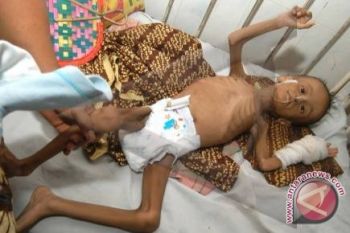 Bupati Mamuju Minta Penderita Gizi Buruk Ditangani