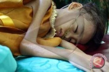 Dinkes tekan jumlah penderita gizi buruk