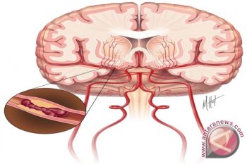  Cuaca panas dapat memicu penyakit stroke