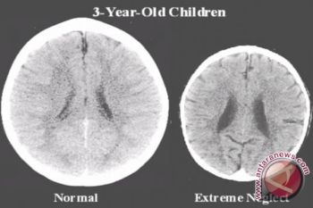 Lemak sehat berperan vital dalam pertumbuhan otak anak