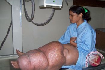 Palangka Raya Bebas Penyakit Kaki Gajah